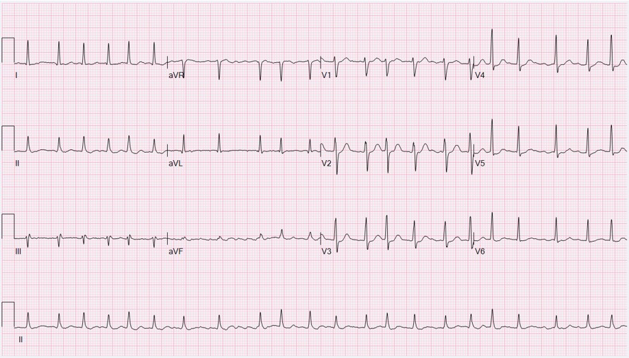ECG showing atrial fibrillation and lack of P-waves.