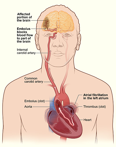 Pathyphysiology of atrial fibrillation-induced stroke.