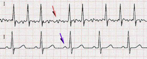 ECG showing the absence of P-waves in atrial fibrillation.